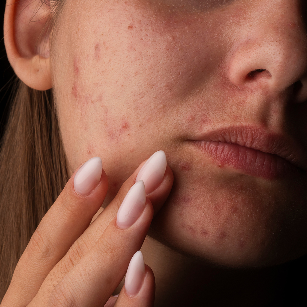 Close-up van een huid met acne